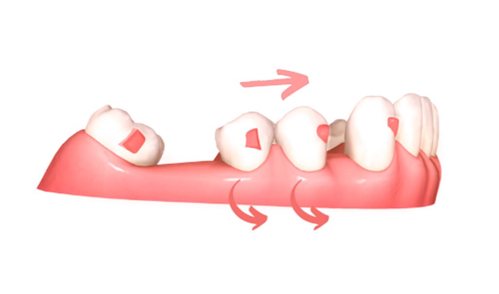 Control del movimiento radicular con alineadores