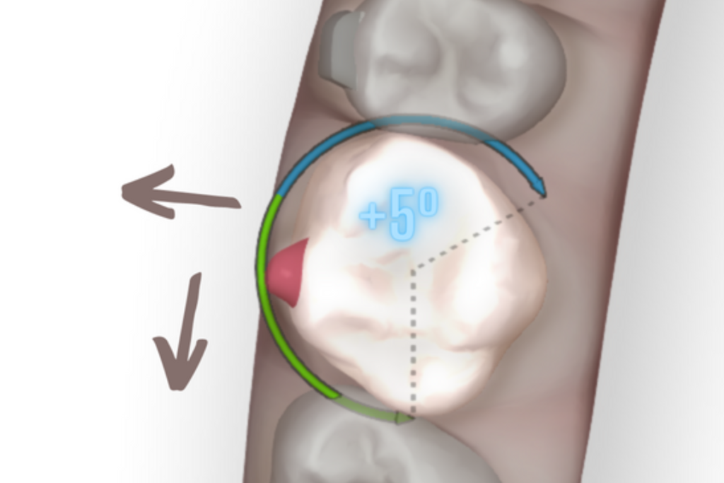 hipercorrección y sobrecorrección Orthoclub academy