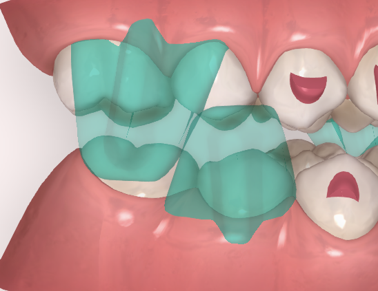 avance mandibular con alineadores - ORTHOCLUB ACADEMY
