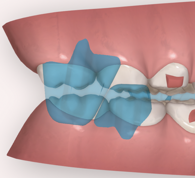 salto virtual vs avance mandibular - ORTHOCLUB ACADEMY