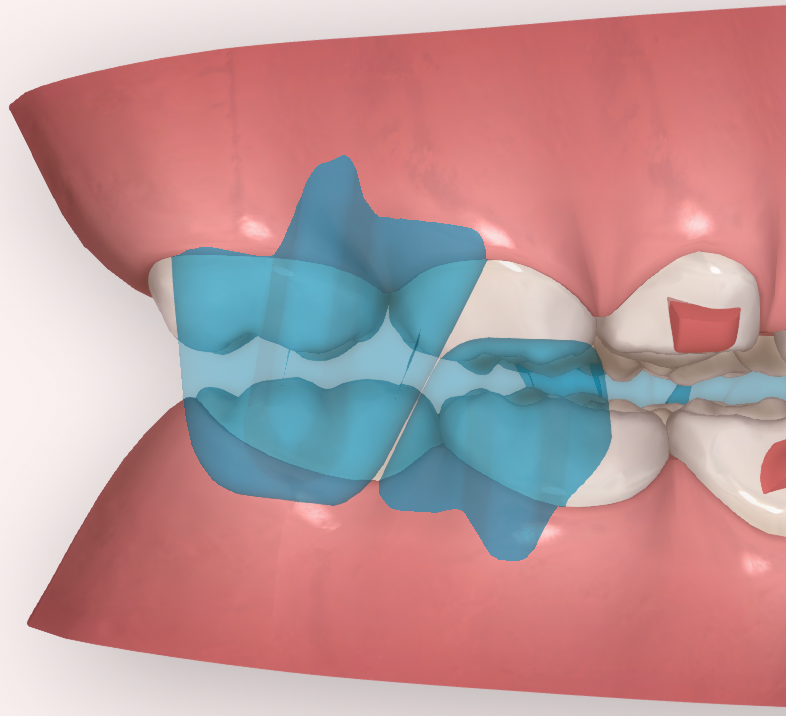 salto virtual vs avance mandibular - ORTHOCLUB ACADEMY