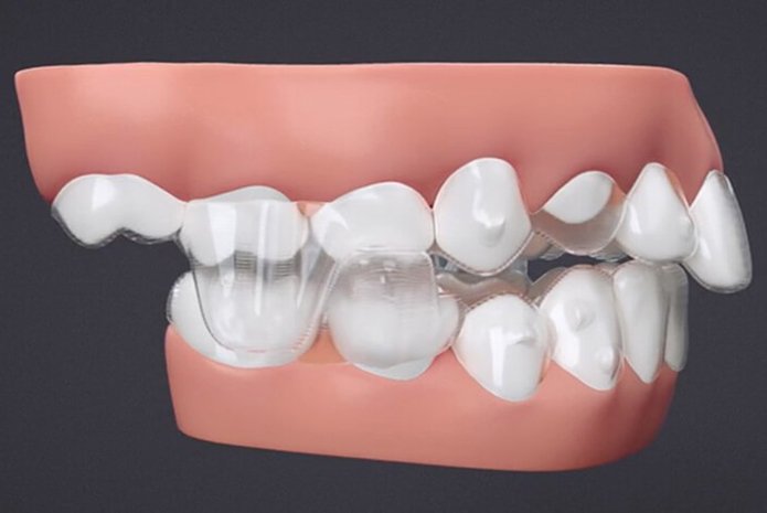 Invisalign y Angel Aligner Avance mandibular por OrthoClub ACADEMY